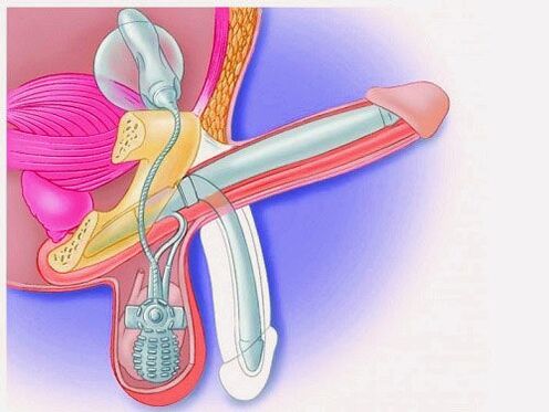 Penis enlargement with penile prosthesis