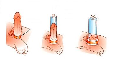 Principle of pump operation to increase penis