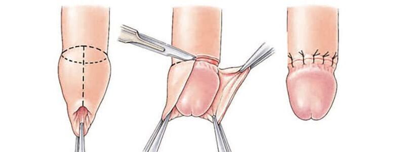 The effect of circumcision on penis size